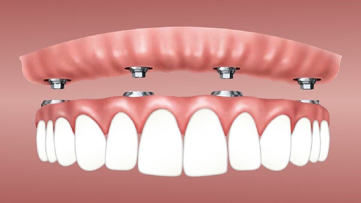 Dental implants: Benefits from a Dentist